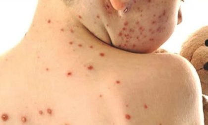 MORBILLO: CASI RADDOPPIATI NEL 2016