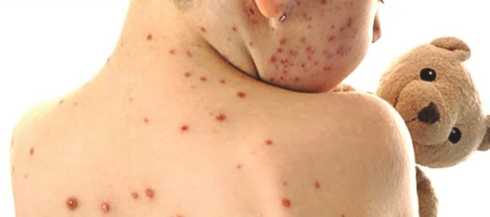 MORBILLO: CASI RADDOPPIATI NEL 2016