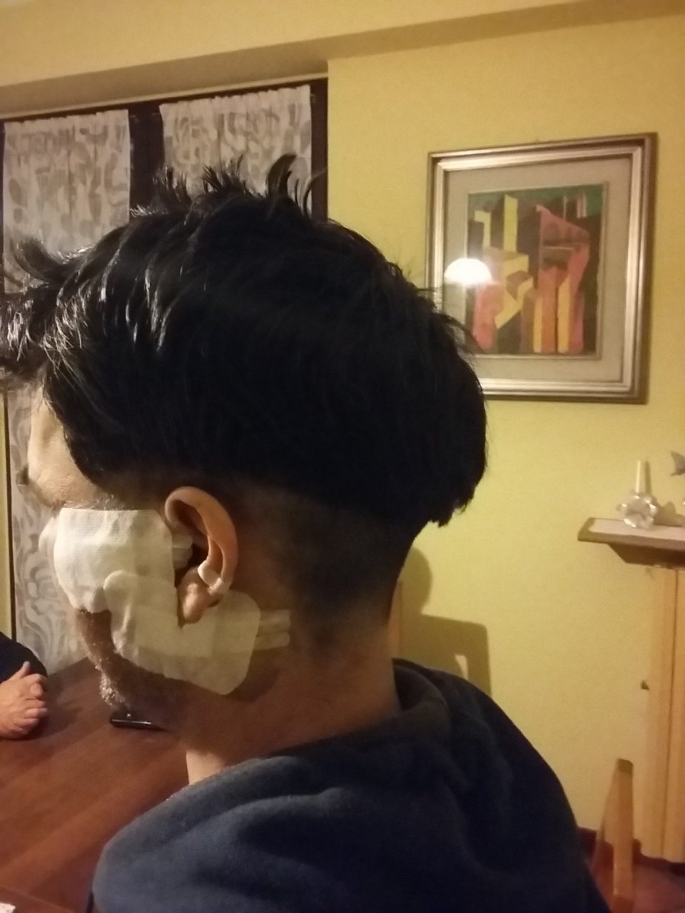 Aggressione al bar Parla il palazzolese ferito con un bicchiere