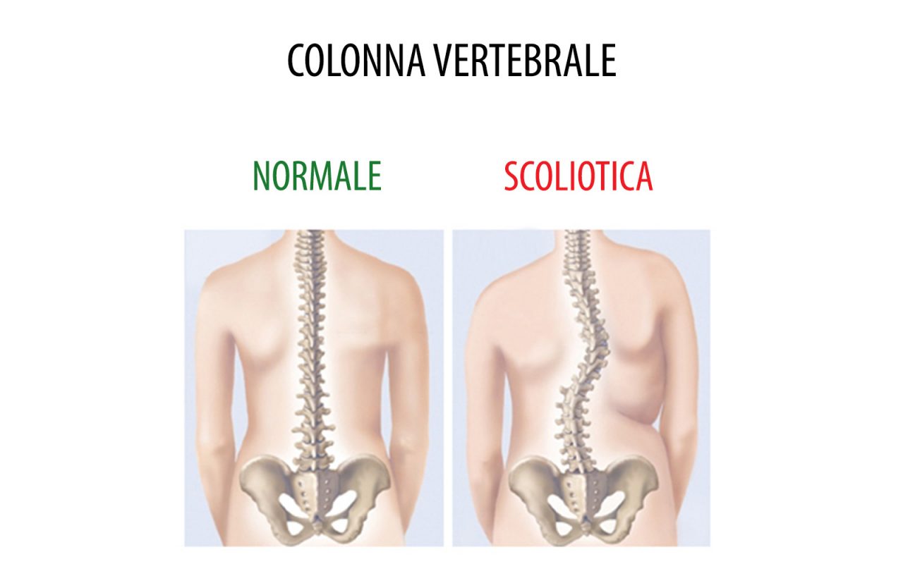 Scoliosi