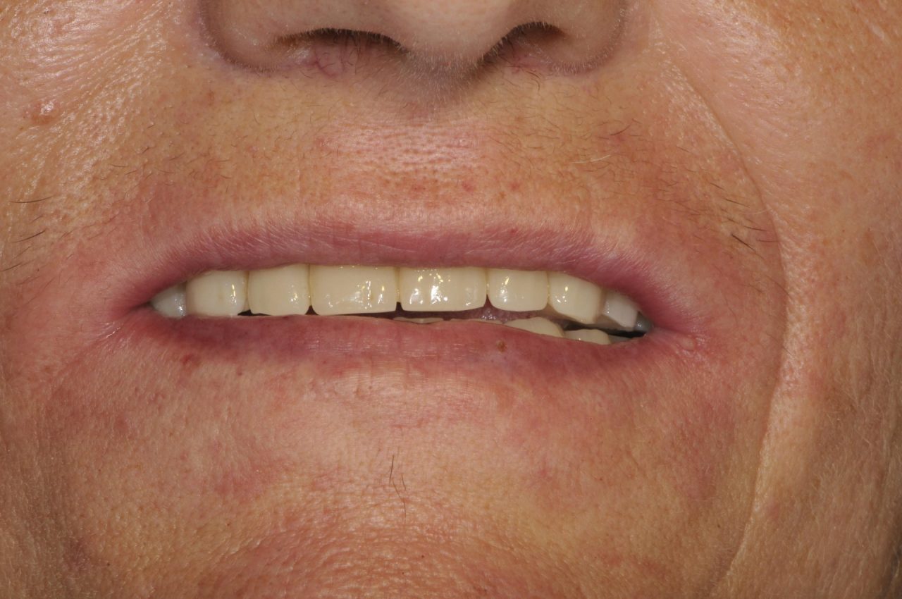 Riabilitazioni dento facciali