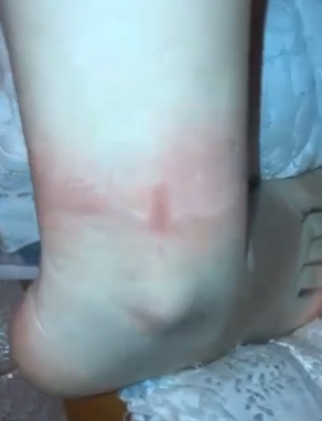 Inciampa in una buca, 16enne finisce all’ospedale