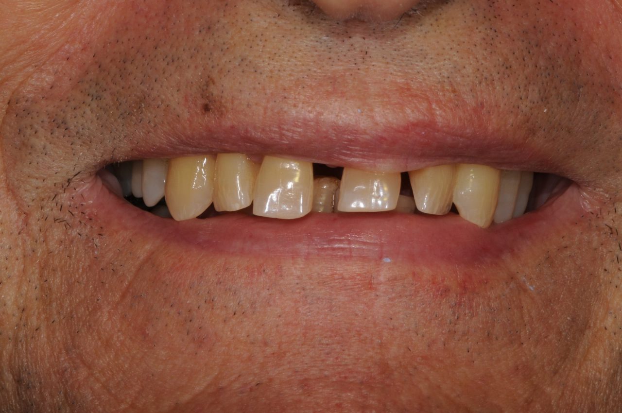 Odontoiatria a carico immediato