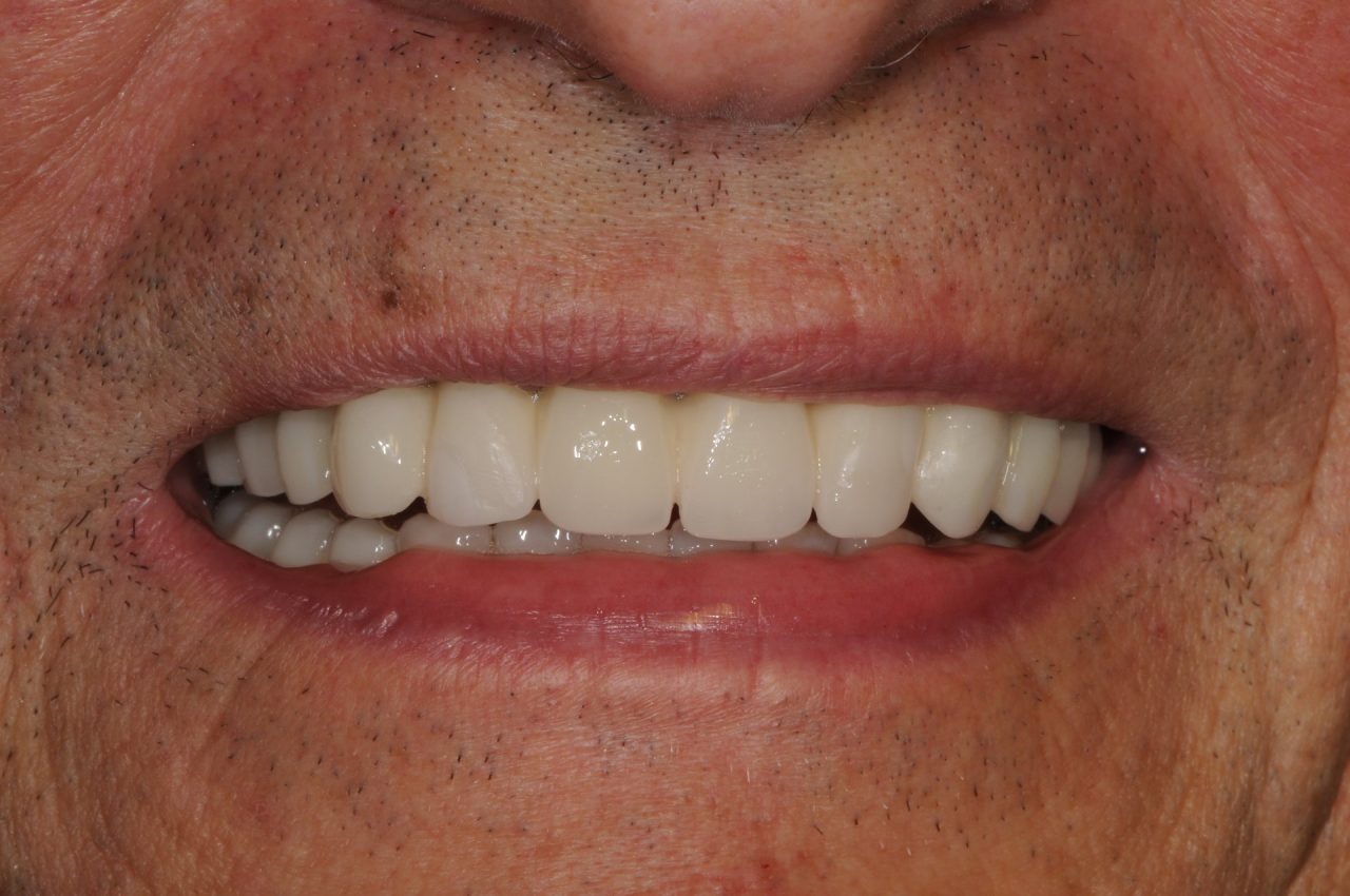 Odontoiatria a carico immediato