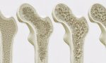 Che cos’è la Moc-Dxa, primo strumento per affrontare l’osteoporosi