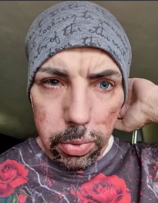 Pezzulo fu sfregiato con l’acido ma per lui nessun riconoscimento