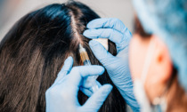 Impianto di capelli: la soluzione ideale per risolvere il problema alla radice