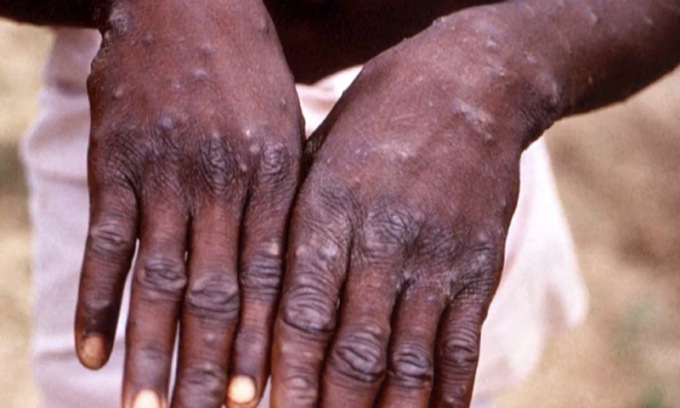 Vaiolo delle scimmie, c’è anche un bresciano tra i contagiati