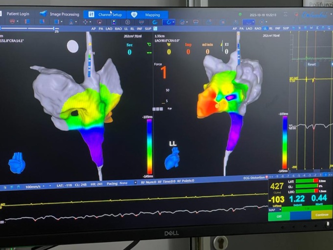 ASST Garda: da tutta Italia in cardiologia a Desenzano per il Training formativo sull’ablazione cardiaca