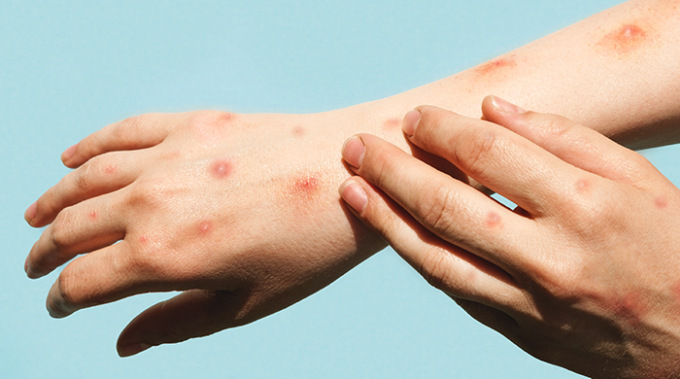 Vaiolo delle scimmie: un caso in Franciacorta