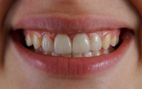 Afta e piccoli segnali del corpo: quando non dovrebbero essere ignorati
