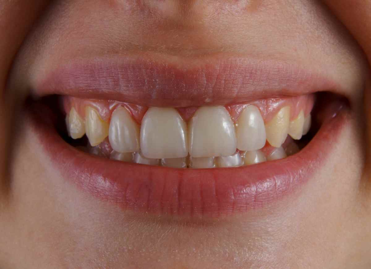 Afta e piccoli segnali del corpo: quando non dovrebbero essere ignorati